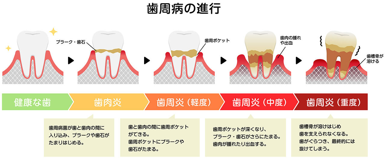 歯周病の進行