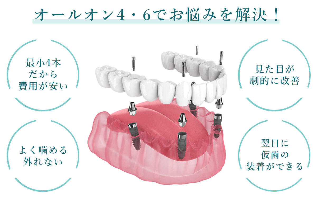 オールオン4・6